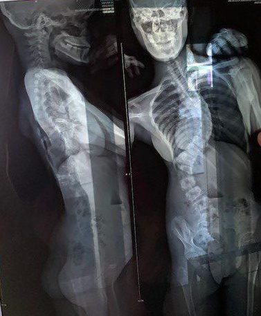 xray of Nicholes spine